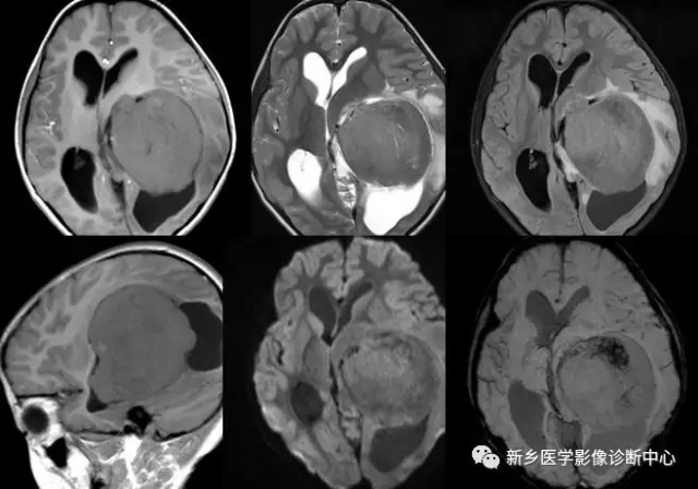 侧脑室肿瘤图片