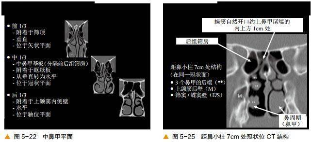 前后筛窦以中鼻甲基板为界,蝶窦及后组筛窦以上鼻甲基板为界