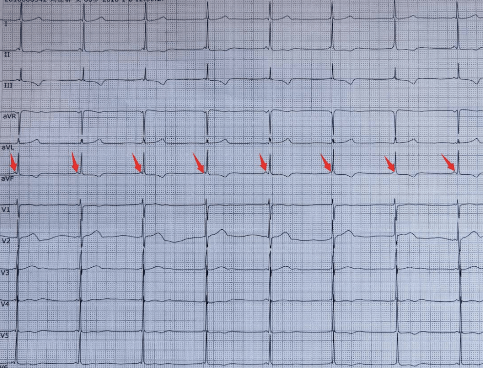 心電圖不會看這10個診斷特徵需牢記