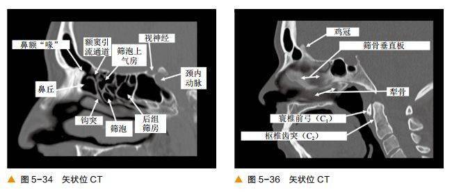 三,矢状位图像前后筛窦以中鼻甲基板为界,蝶窦及后组筛窦以上鼻甲基板