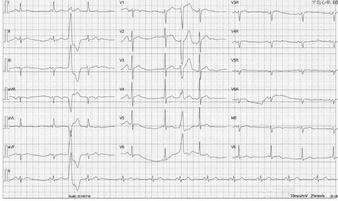 室上性早搏的心电图图片