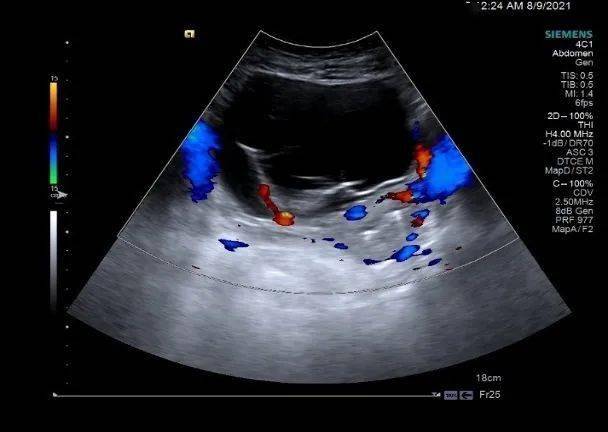 左侧卵巢交界性粘液性肿瘤1例