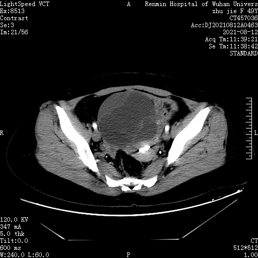卵巢肿瘤图片b超图片