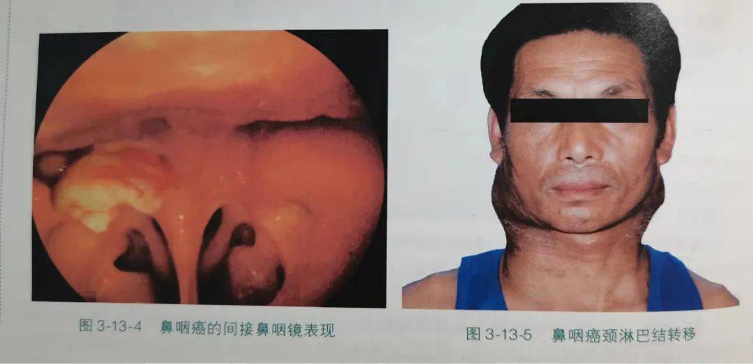 鼻咽癌早期症状 初期图片