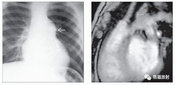 (左)ps患者的pa胸片显示肺动脉主干增大,与肺动脉狭窄患者的狭窄后