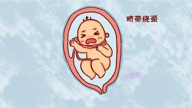 脐带绕颈胎儿窒息?胎儿五花大绑早产?别着急!