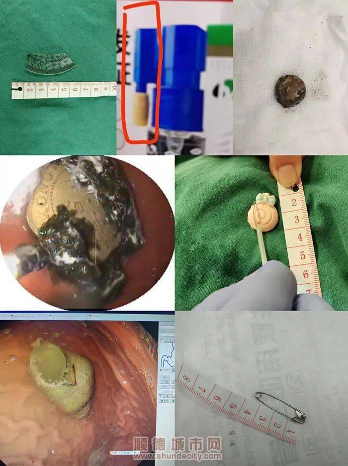 可怕顺德3岁宝宝吞下了6厘米二极管结果