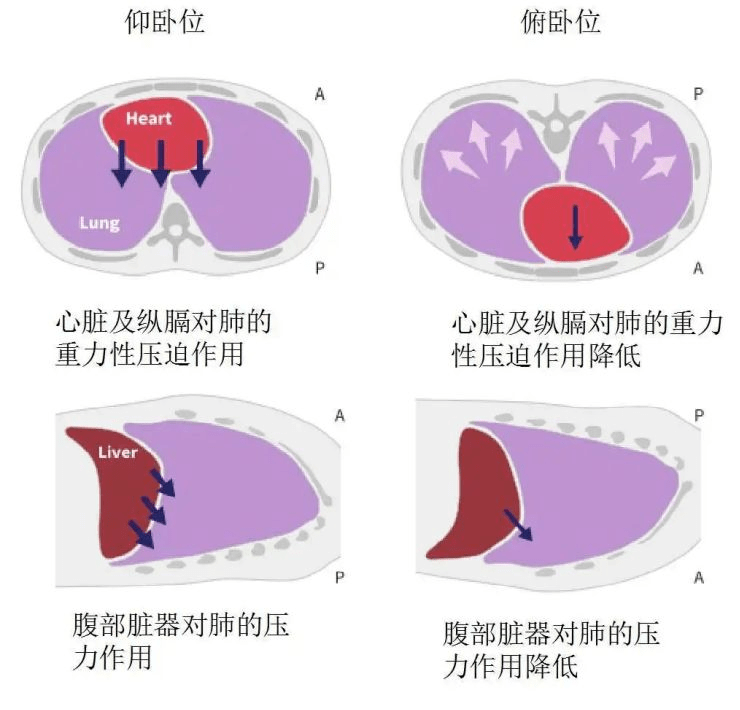 俯卧位通气原理图片图片