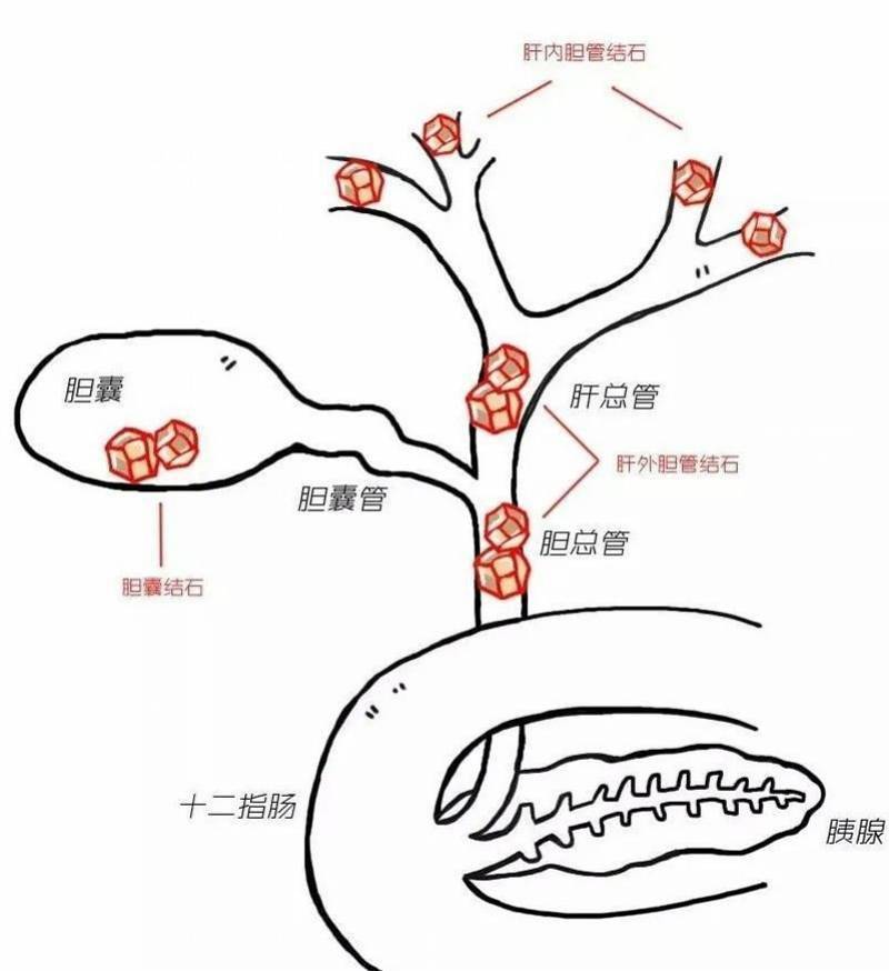 手术|腹痛剧烈快速变成“小黄人”，胆总管结石其实是种很危险肝病