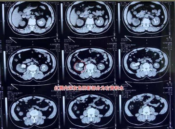 手术|男子每天腰痛到全身冒汗，入院就医才知道……