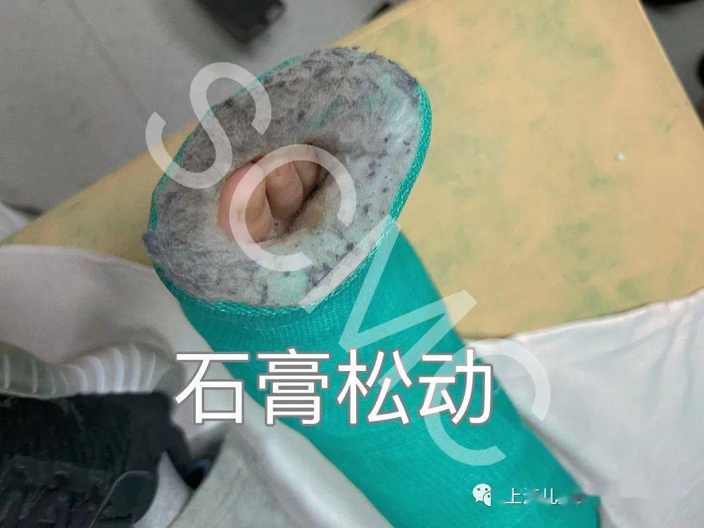 儿子脚骨折打石膏 9bb4e2788a3d4ce9b2572bf6fd4c7fa4.jpeg
