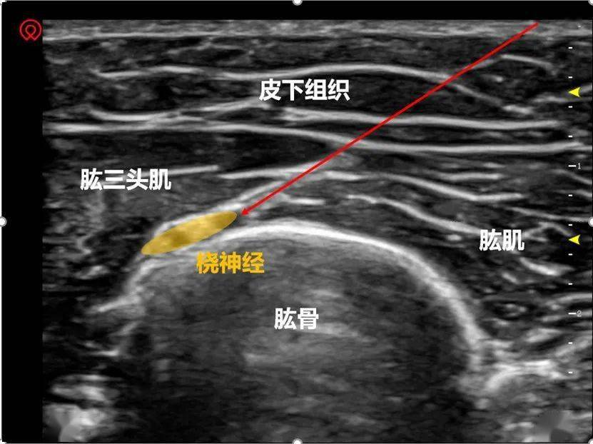 阻滯穿刺針從探頭前端進針,調整角度緩慢向橈神經推進,穿過肱肌後到達