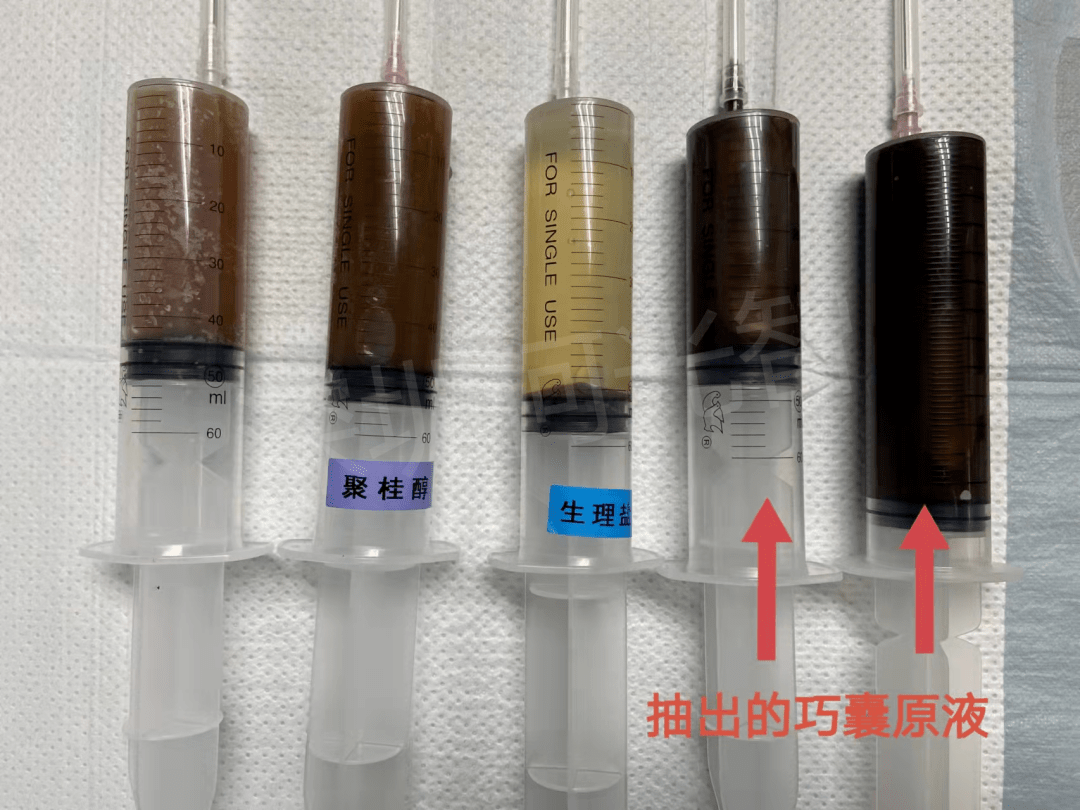 何光智|女子盆腔深部长多个巧克力囊肿，超声介入硬化治疗后囊肿消失