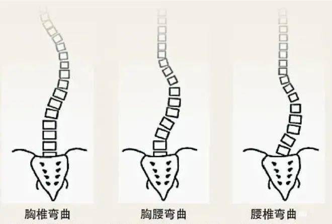 腰椎右侧弯示意图图片