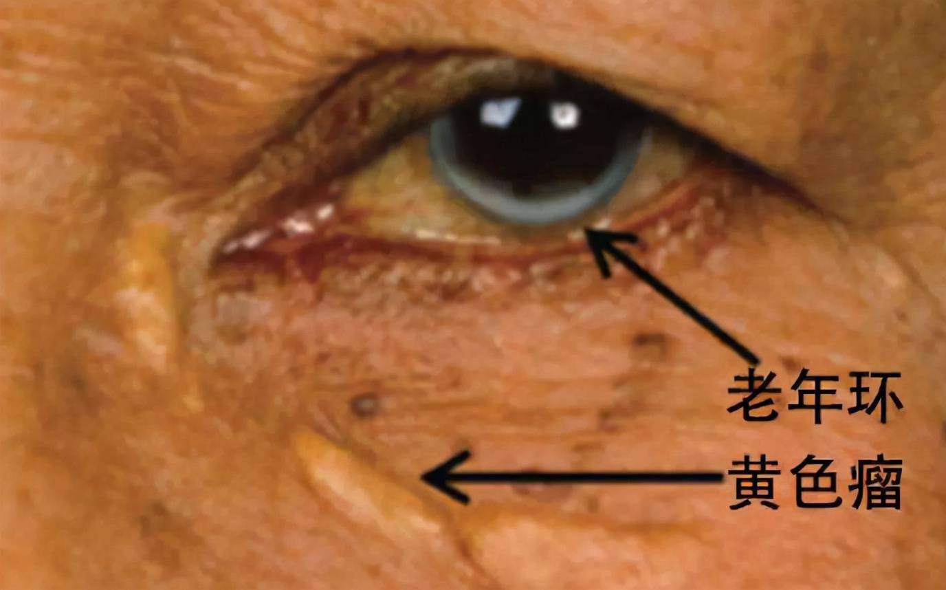 眼睛有3种症状暗示血脂已经超标医生餐桌3物赶紧撤下