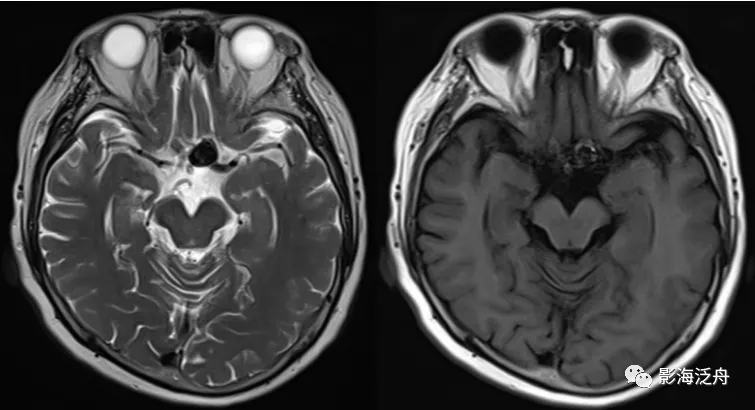 诊断|颅脑MR平扫中极易漏诊的点