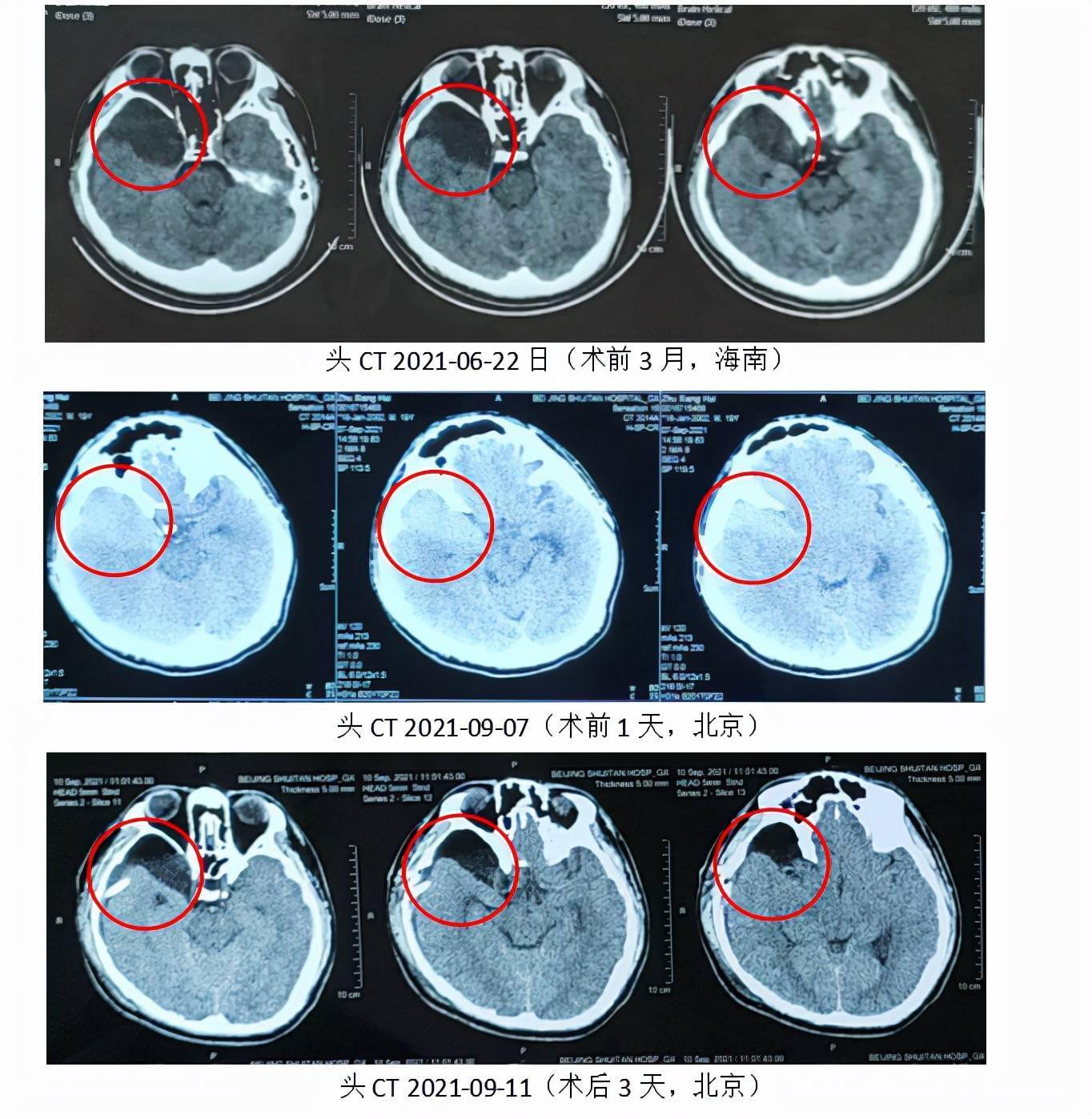 入院时患者头疼明显加重,伴恶心呕吐,头ct提示"硬膜下及蛛网膜囊肿内
