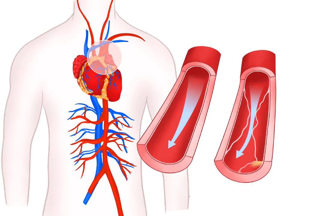 蓬莱疾控:心血管病人如何过冬_症状_循环系统_食物