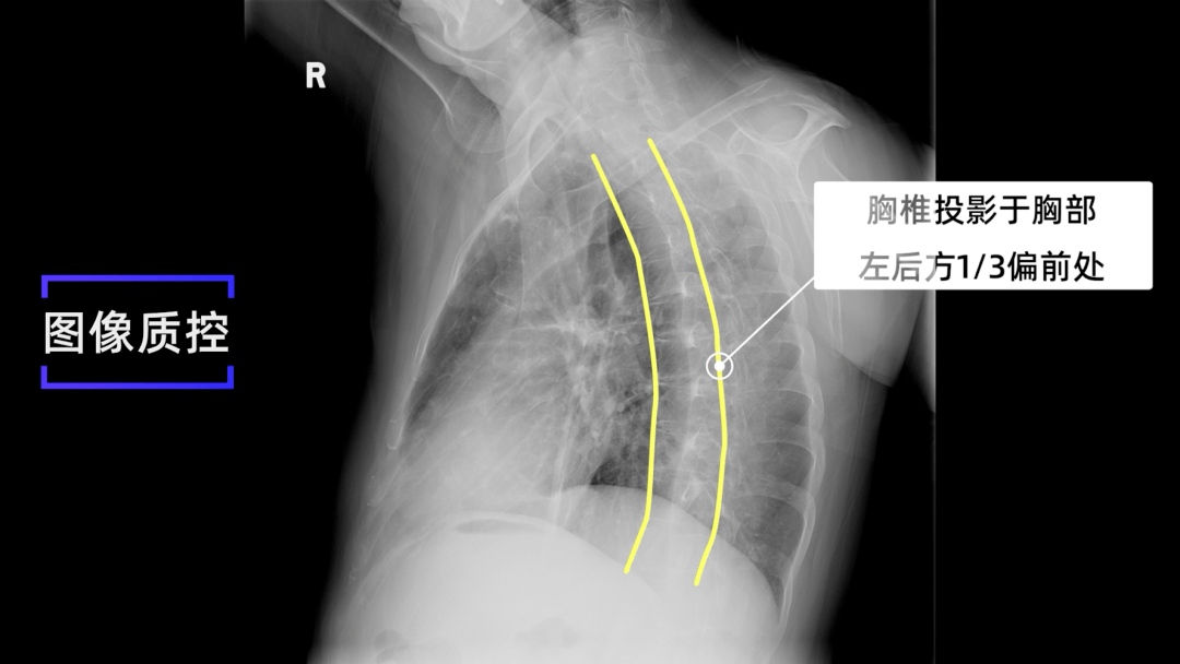 X线规范化检查 | 胸部左、右前斜位摄影（视频及图文详解）_影像_探测器_胸椎