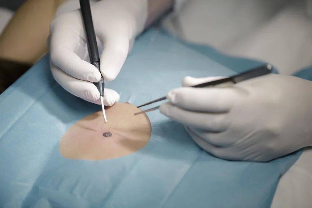 治疗_电灼_皮肤