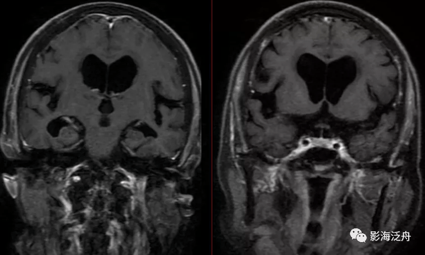 诊断|小心误诊，这可不是单纯的脑萎缩