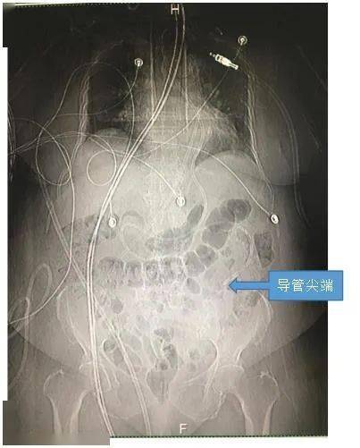 电磁|深圳恒生医院ICU成功开展首例电磁导航下床旁鼻肠管置入术