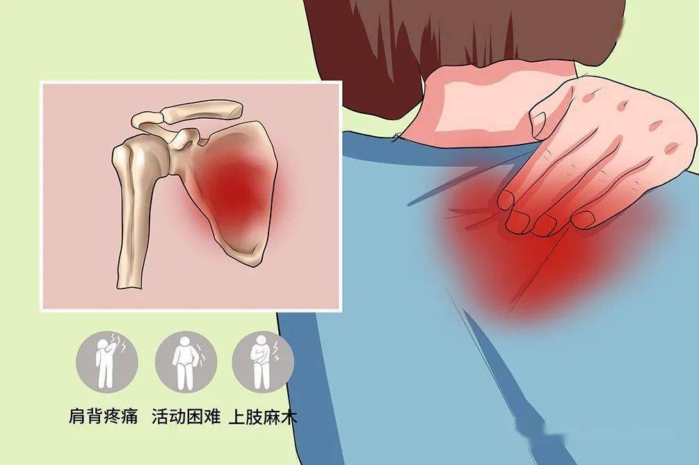 肩胛骨下方疼痛图片