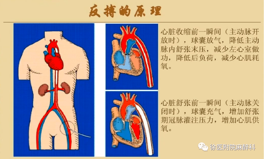 iabp 禁忌證,如主動脈瓣膜關閉不全,主動脈竇瘤及主動脈夾層,下肢缺血