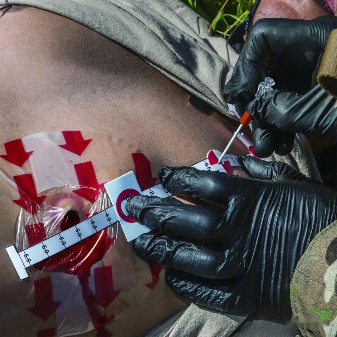 战场上,"争口气"也是技术活:战术急救呼吸保障技术_伤员_气道_气管