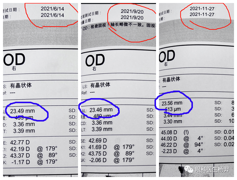 冬季眼軸會加速增長眼科醫生楊羿應從這4方面調整近視防控方案