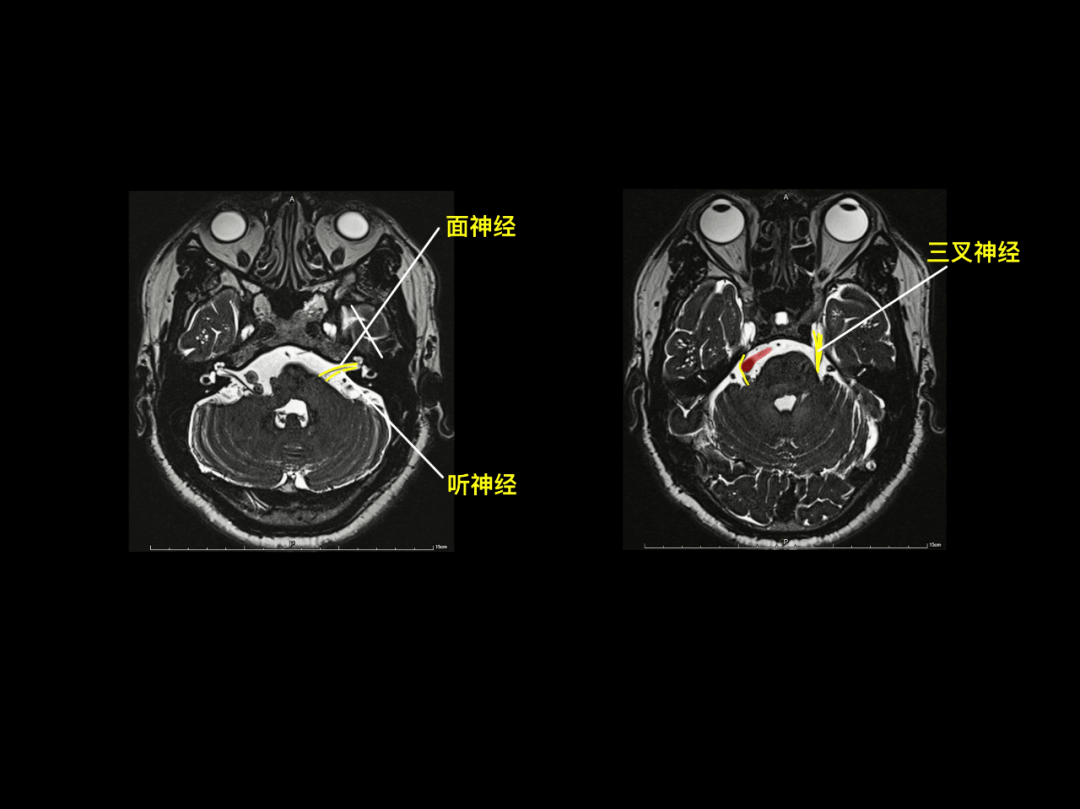 脑干:延髓,脑桥,中脑海马脑叶,基底节区额下回,颞