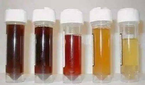 1,没有尿液颜色异常:一般情况下,我们尿液的颜色为淡黄色,而早上晨尿