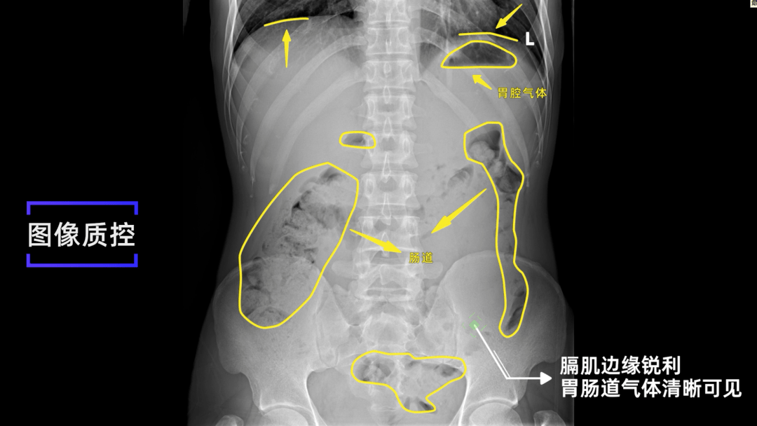 纵隔疝x线图片图片