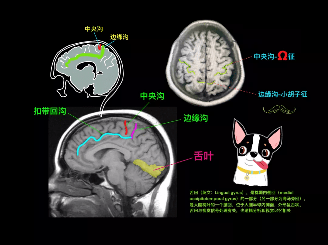 颅脑mr 阅片手绘 (二)