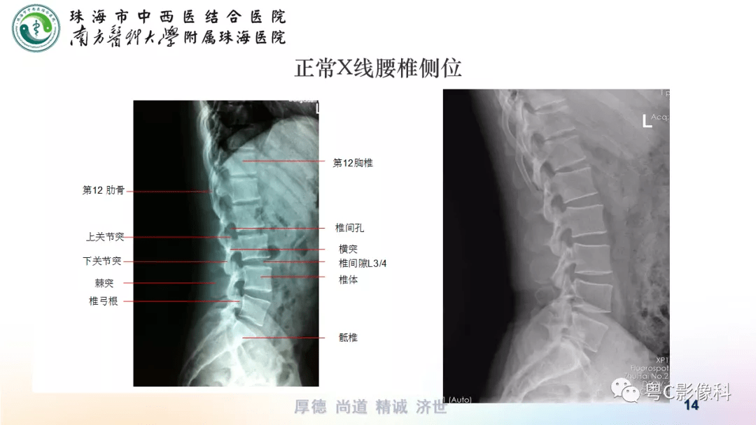 腰椎斜位x线摆位方法图片