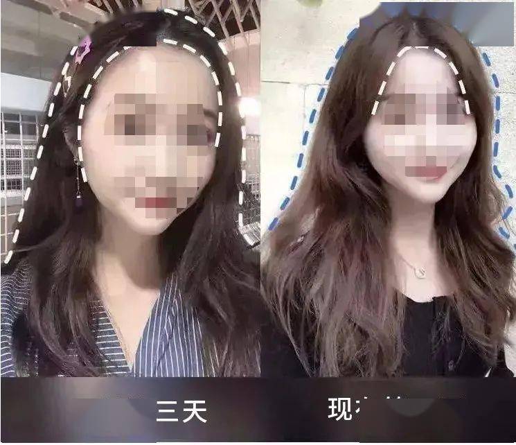 尸体头上抠下来的白泥竟是螨虫尸体!头痒头屑出油多,用它就对了