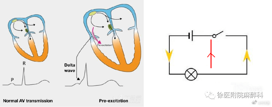 专题| 预激综合征的麻醉管理(徐医附院麻醉科)_心电图_旁路_窦性