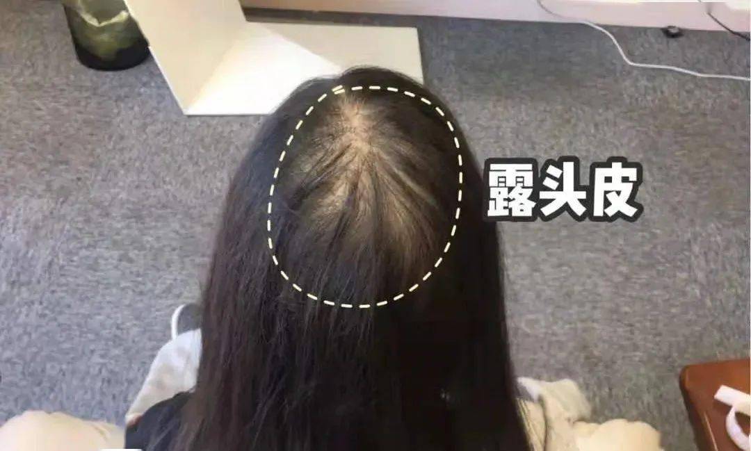 尸体头上抠下来的白泥竟是螨虫尸体!头痒头屑出油多,用它就对了