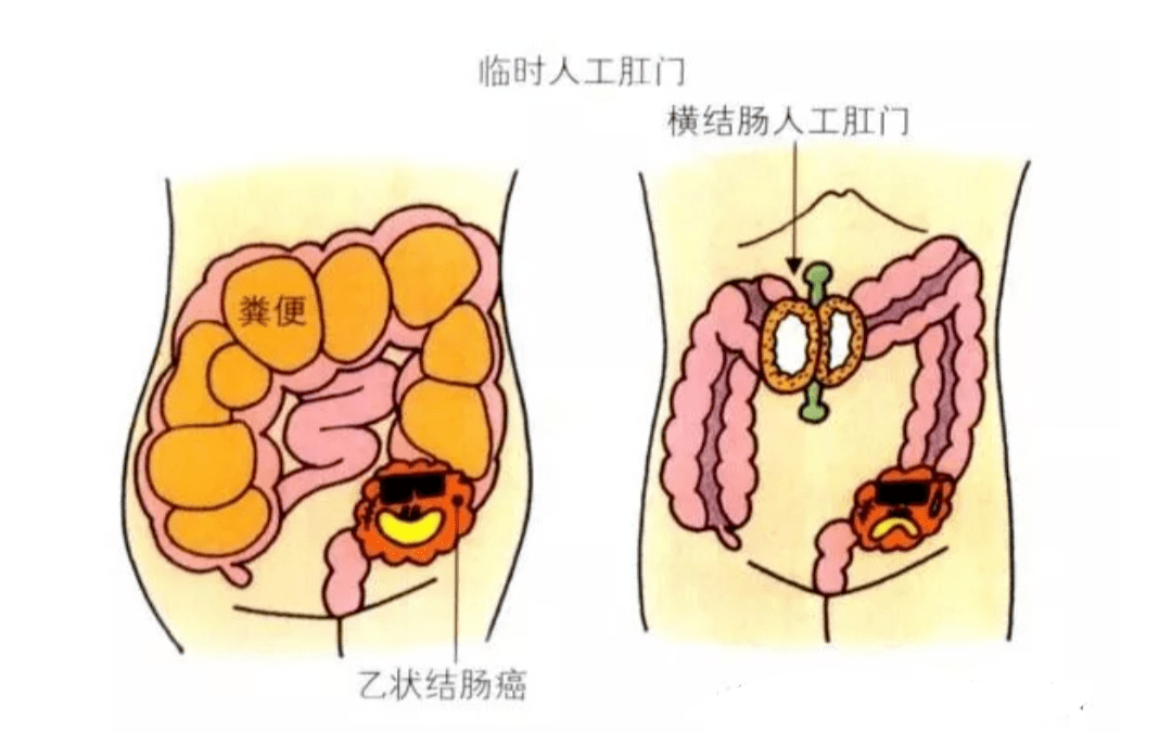 春节健康系列科普丨不同寻肠,与您一起认识肠梗阻