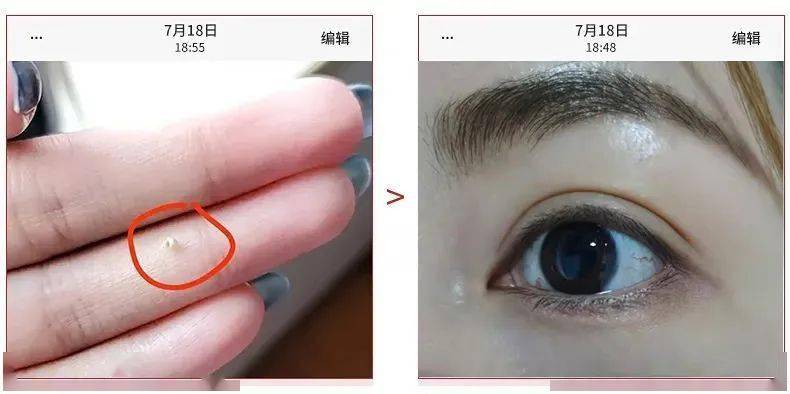 医学长了脂肪粒到底挤不挤?一分钟教你处理它的正确姿势!