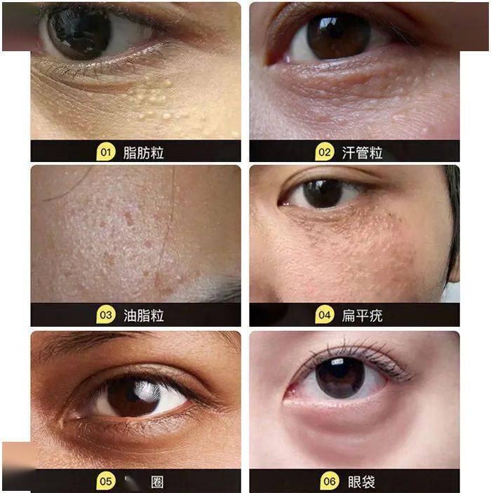 医学长了脂肪粒到底挤不挤?一分钟教你处理它的正确姿势!