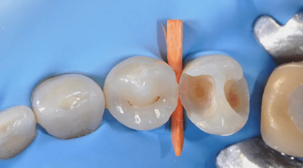 原因包括修复体飞边折断;树脂材料自身聚合收缩;夹在充填体和洞侧壁或