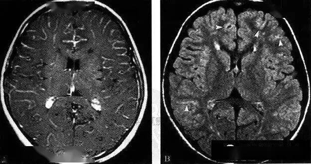 moyamoya病,仅凭一层ct图像即可确诊的疾病_血管_诊断_yoon