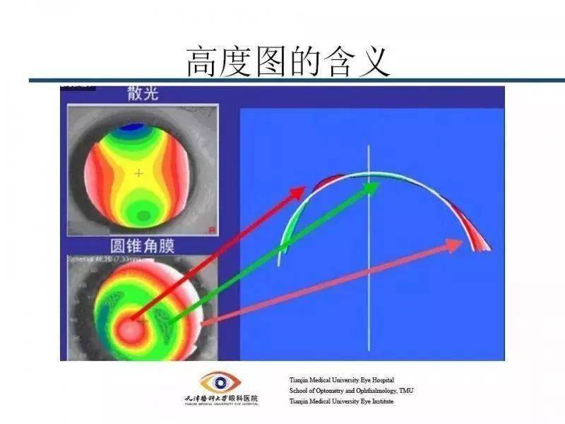 角膜地形图报告单解析图片