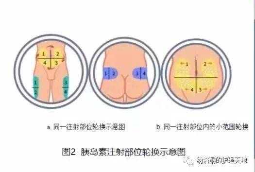 戈那瑞林注射位置图片