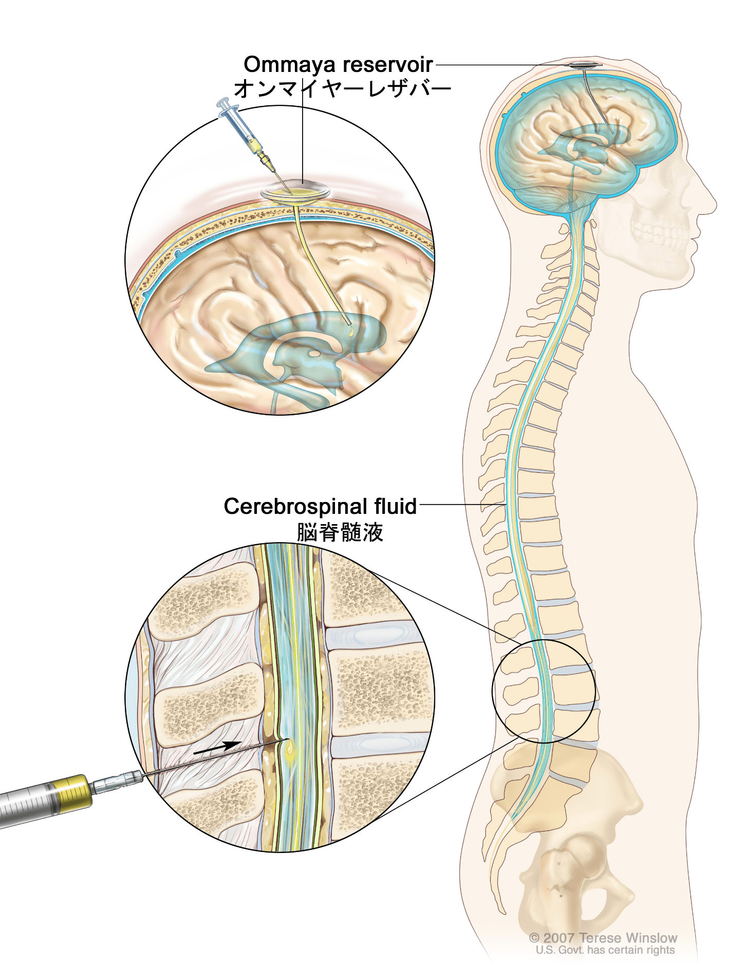 三种脑膜炎脑脊液特点 4大脑膜炎脑脊液鉴别