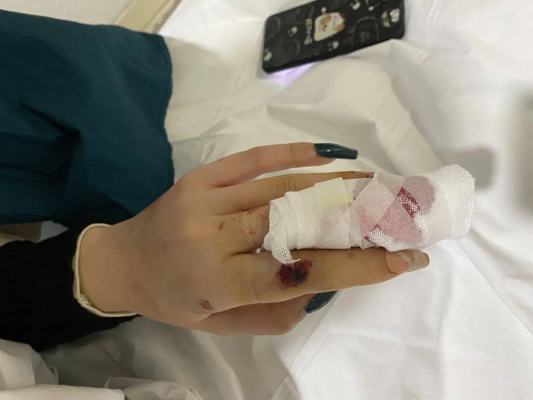瞬间撬断指骨医生视角告诉你美甲有多厉害