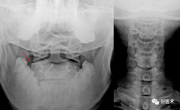 可出现以下征象双边征:即某1或2个椎体后缘呈双边状,颈椎旋转5