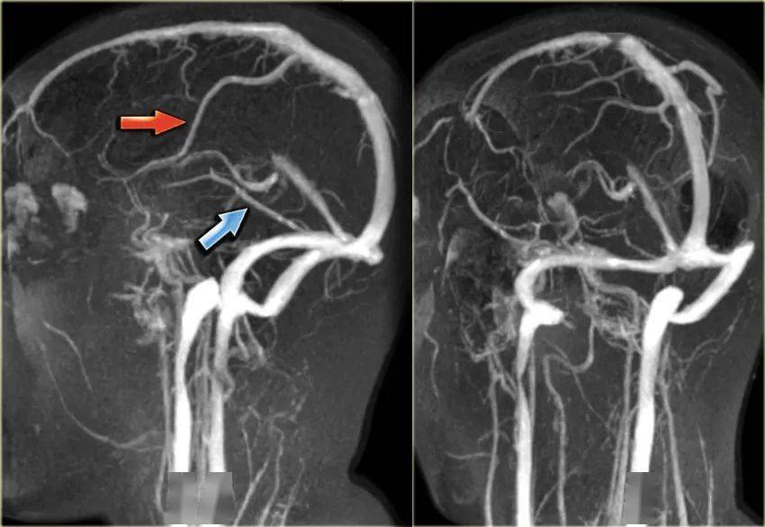 一位静脉血栓形成患者的左侧图像, 有血栓形成上矢状窦(红色箭头),直