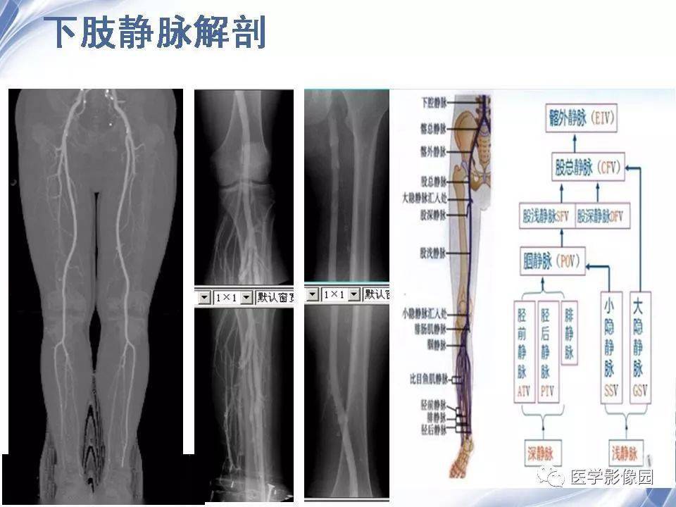 下肢静脉造影的临床应用